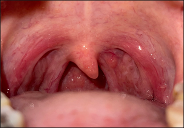 Osteopathy: Inspection of uvula and palatine arches