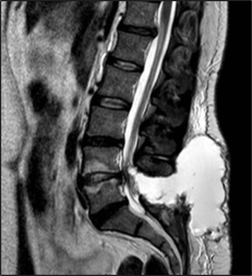 Osteopathy: be aware of a cerebrospinal leak