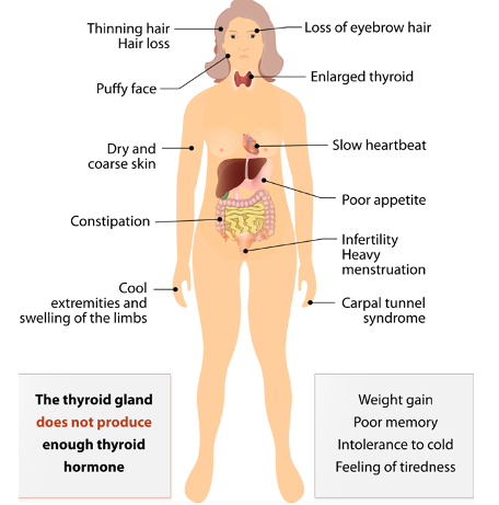 Hypothyroidism