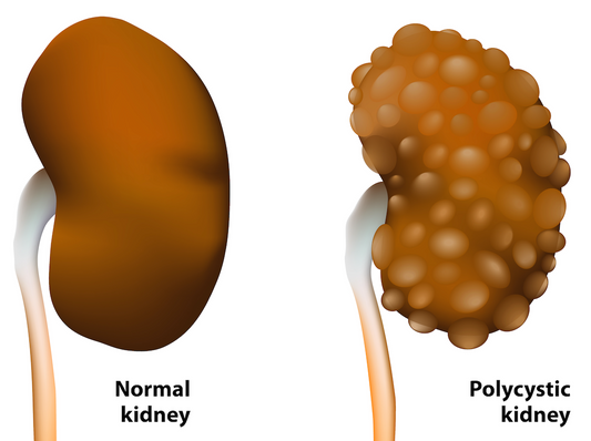 Osteopathy: Kidney cysts and abdominal pain