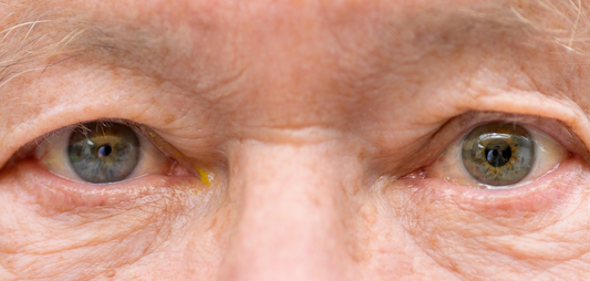 Anisocoria: possible causes