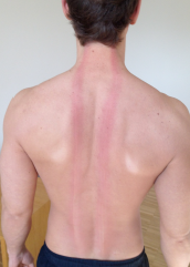 Red Reflex Test or Triple Response of Lewis