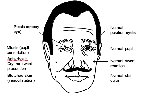 Osteopathy: Horner syndrome