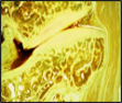 Osteopathy and meniscoids