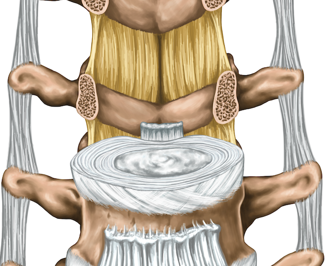 Ligamentum Flavum (yellow ligament) Thickening and Low Back Pain