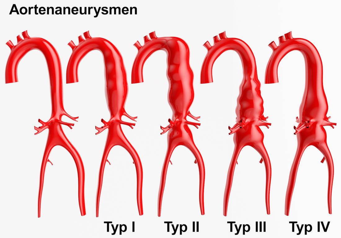 How and where to palpate an Abdominal Aortic Aneurism?