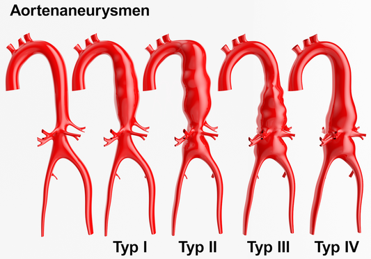 How and where to palpate an Abdominal Aortic Aneurism?
