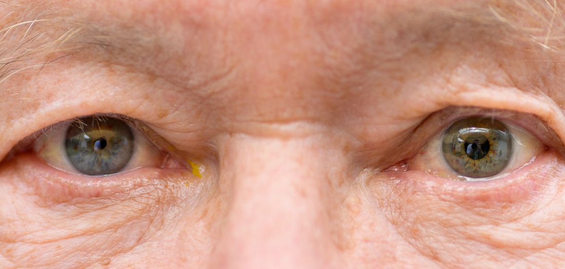 Anisocoria: possible causes