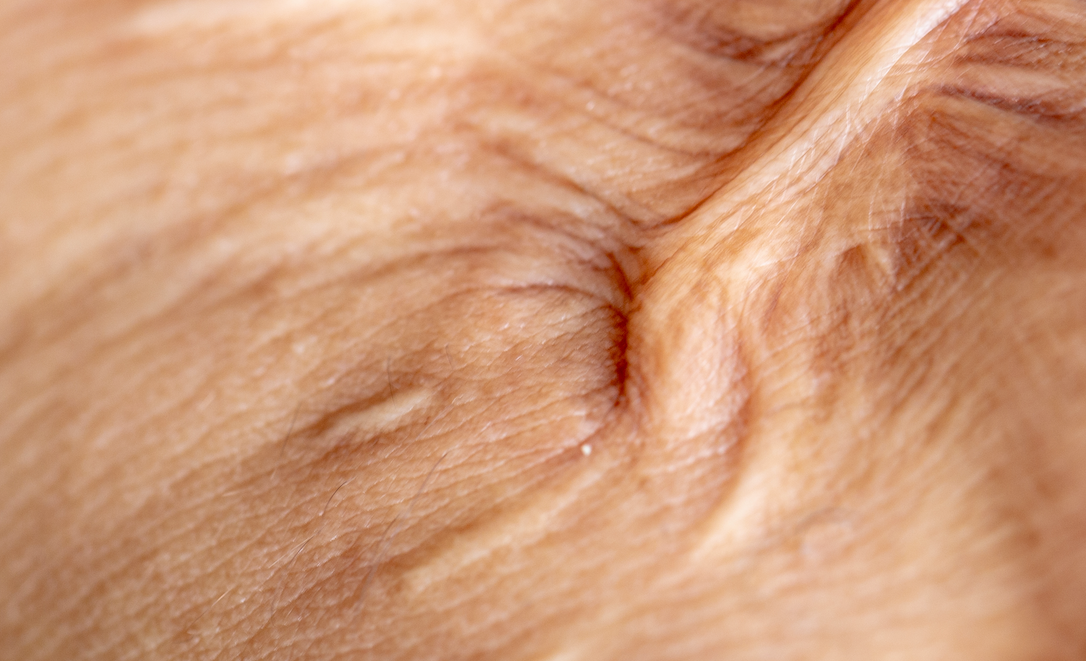 Osteopathy: Complex regional pain syndrome