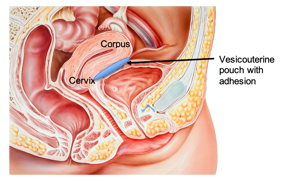 Osteopathy: Low back pain can be caused by visceral adhesions in the pelvis